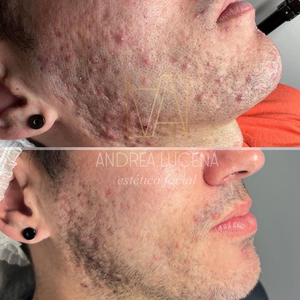 antes y despues tratamiento facial masculino