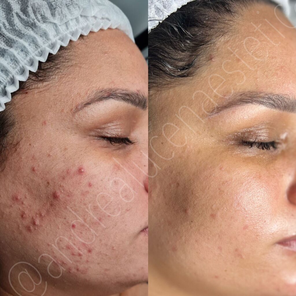 antes y despues trataiento facial